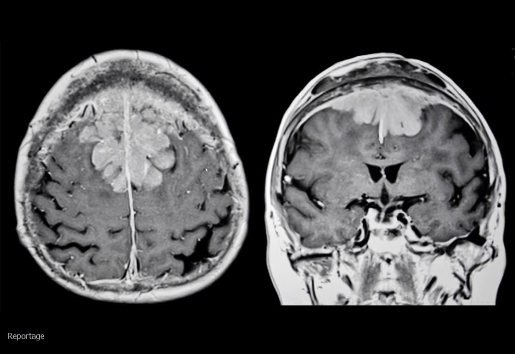 علائم و درمان تومور مغزی