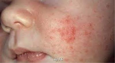 طغیان سرخک در افغانستان و ضرورت آمادگی دانشگاه های علوم پزشکی