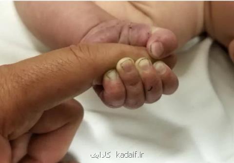 جنجال بر سر تولد نوزادان بدون دست در فرانسه